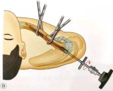 Diagnosis And Treatment Of Clavicle Fracture-20 Диагноз и лечение перелома ключицы-20