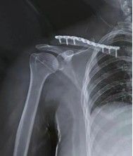 Diagnosis And Treatment Of Clavicle Fracture-24 Диагноз и лечение перелома ключицы-24