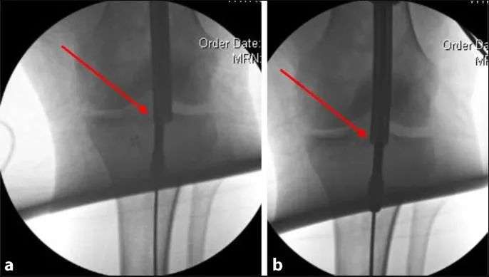 Tibial fractures, suprapatellar intramedullary nail technique-23 Переломы большеберцовой кости, супрапателлярная интрамедуллярная техника стержня-23