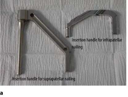 Tibial fractures, suprapatellar intramedullary nail technique-16 Переломы большеберцовой кости, супрапателлярная техника интрамедуллярного стержня-16