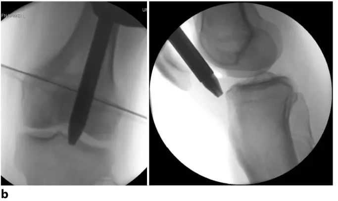 Tibial fractures, suprapatellar intramedullary nail technique-8 Переломы большеберцовой кости, супрапателлярная интрамедуллярная техника стержня-8