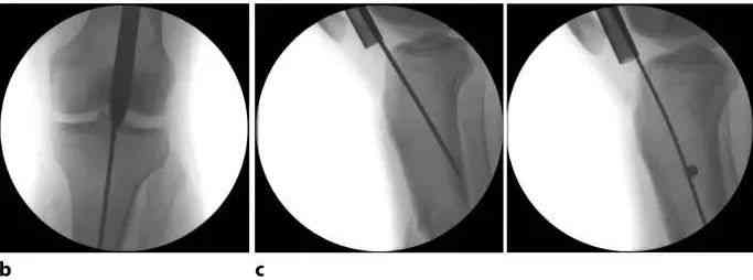 Tibial fractures, suprapatellar intramedullary nail technique-11 Переломы большеберцовой кости, супрапателлярная интрамедуллярная техника стержня-11
