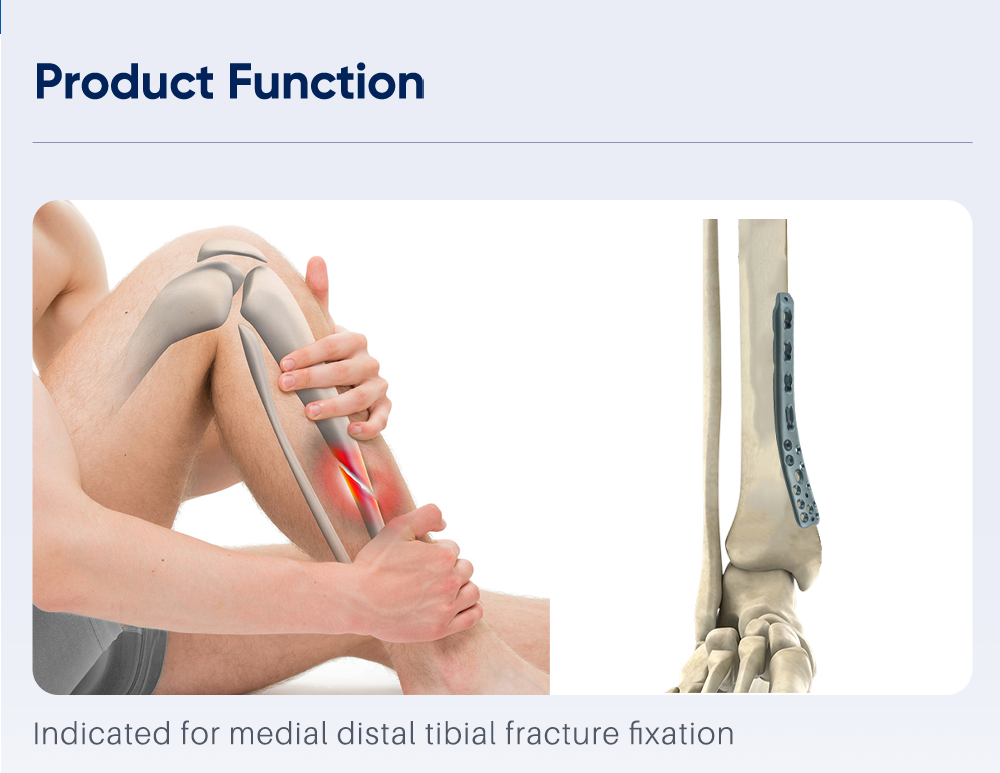 Medial Polyaxial Plate for Distal Tibia - Buy Product on XC Medico Медиальная полиаксиальная пластина для