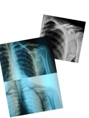 Diagnosis And Treatment Of Clavicle Fracture-4 Диагноз и лечение перелома ключицы-4