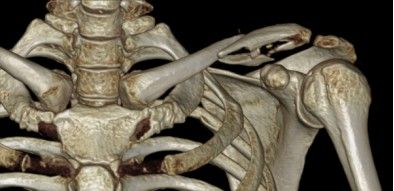 Diagnosis And Treatment Of Clavicle Fracture-9 Диагностика и лечение перелома ключицы-9