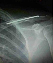 Diagnosis And Treatment Of Clavicle Fracture-22 Диагноз и лечение перелома ключицы-22