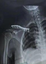 Diagnosis And Treatment Of Clavicle Fracture-25 Диагноз и лечение перелома ключицы-25