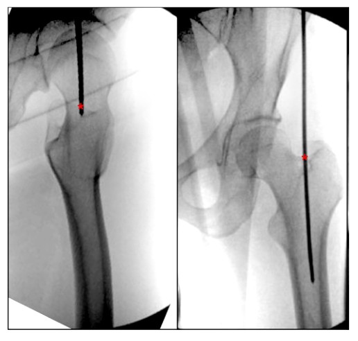 Femoral Intramedullary Nailing - How To Choose The Best Insertion Point-4 Бедренный интрамедуллярный гвоздь – как выбрать лучшую точку введения-4