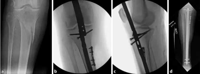 Tibial fractures, suprapatellar intramedullary nail technique-21 Переломы большеберцовой кости, супрапателлярная техника интрамедуллярного стержня-21