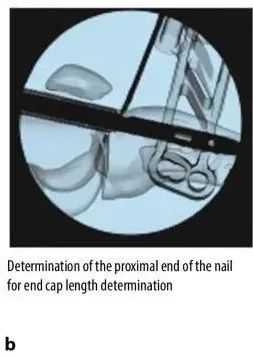 Tibial fractures, suprapatellar intramedullary nail technique-19 Переломы большеберцовой кости, супрапателлярная техника интрамедуллярного стержня-19