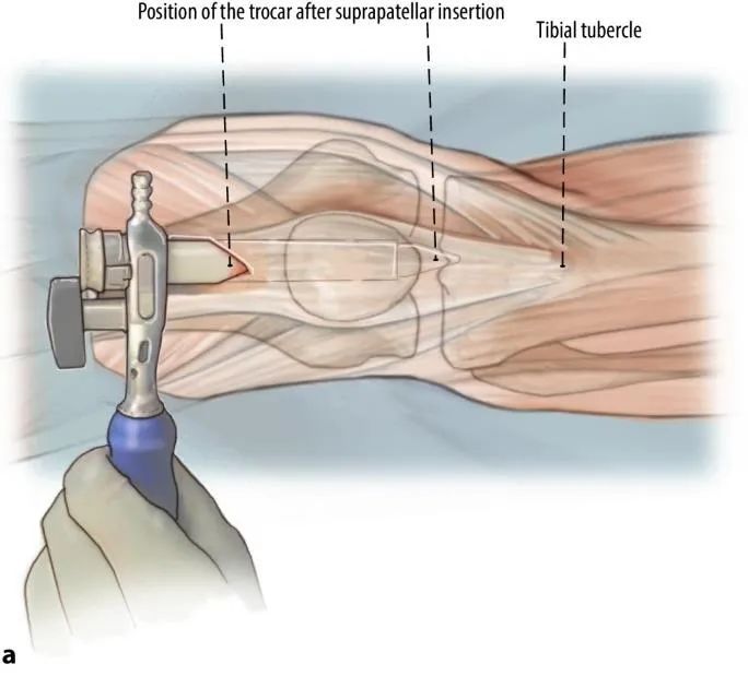 Tibial fractures, suprapatellar intramedullary nail technique-7 Переломы большеберцовой кости, супрапателлярная техника интрамедуллярного стержня-7