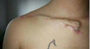 Diagnosis And Treatment Of Clavicle Fracture-30 Диагноз и лечение перелома ключицы-30