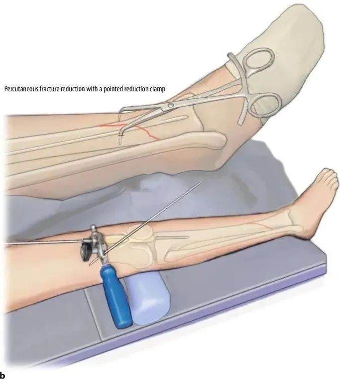 Tibial fractures, suprapatellar intramedullary nail technique-15 Переломы большеберцовой кости, супрапателлярная интрамедуллярная техника стержня-15