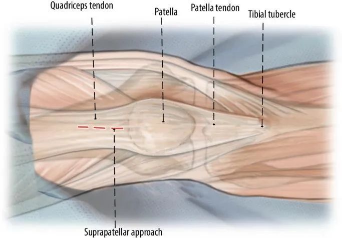 Tibial fractures, suprapatellar intramedullary nail technique-5 Переломы большеберцовой кости, супрапателлярная интрамедуллярная техника стержня-5