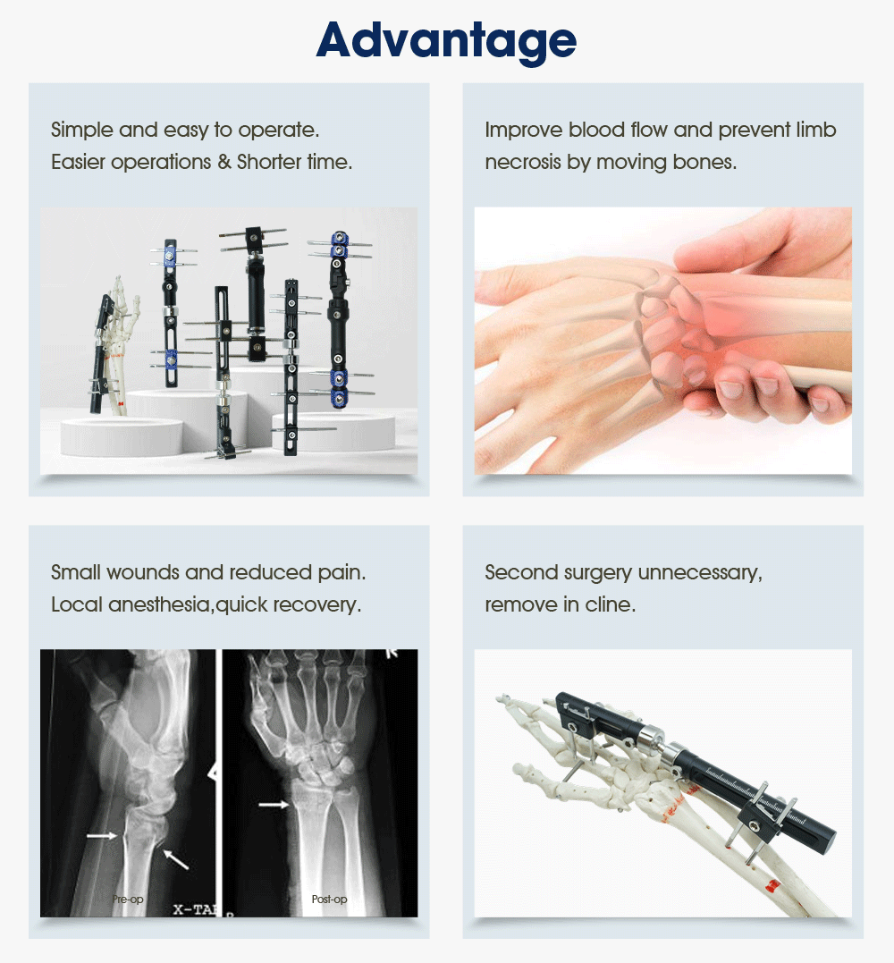 Wrist External Fixator - Buy Product on XC Medico Внешний фиксатор запястья — покупка продукта на XC Medico