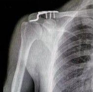 Diagnosis And Treatment Of Clavicle Fracture-26 Диагноз и лечение перелома ключицы-26