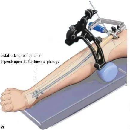 Tibial fractures, suprapatellar intramedullary nail technique-18 Переломы большеберцовой кости, супрапателлярная техника интрамедуллярного стержня-18