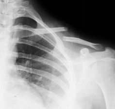 Diagnosis And Treatment Of Clavicle Fracture-3 Диагностика и лечение перелома ключицы-3