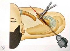 Diagnosis And Treatment Of Clavicle Fracture-19 Диагноз и лечение перелома ключицы-19