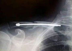 Diagnosis And Treatment Of Clavicle Fracture-21 Диагноз и лечение перелома ключицы-21