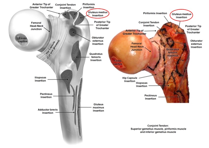 Femoral Intramedullary Nailing - How To Choose The Best Insertion Point-2 Бедренный интрамедуллярный гвоздь – как выбрать лучшую точку введения-2