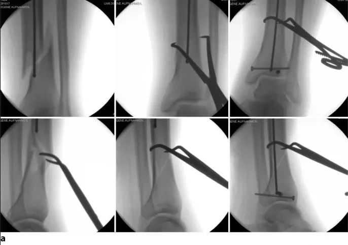 Tibial fractures, suprapatellar intramedullary nail technique-14 Переломы большеберцовой кости, супрапателлярная техника интрамедуллярного стержня-14