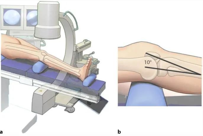 Tibial fractures, suprapatellar intramedullary nail technique-4 Переломы большеберцовой кости, супрапателлярная техника интрамедуллярного стержня-4