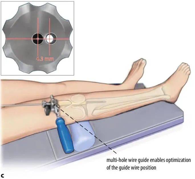 Tibial fractures, suprapatellar intramedullary nail technique-9 Переломы большеберцовой кости, супрапателлярная интрамедуллярная техника стержня-9