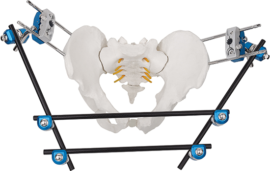 Surgeries Using External Fixators Операции с использованием внешних фиксаторов