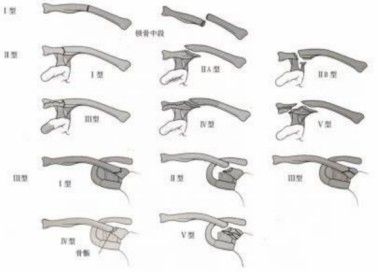 Diagnosis And Treatment Of Clavicle Fracture-12 Диагноз и лечение перелома ключицы-12
