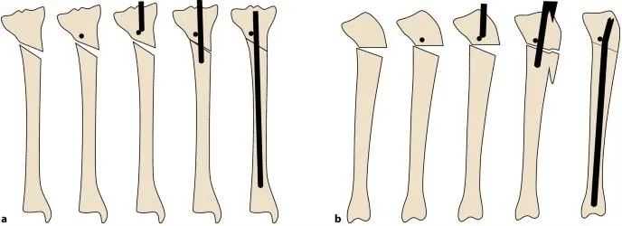 Tibial fractures, suprapatellar intramedullary nail technique-20 Переломы большеберцовой кости, супрапателлярная интрамедуллярная техника стержня-20