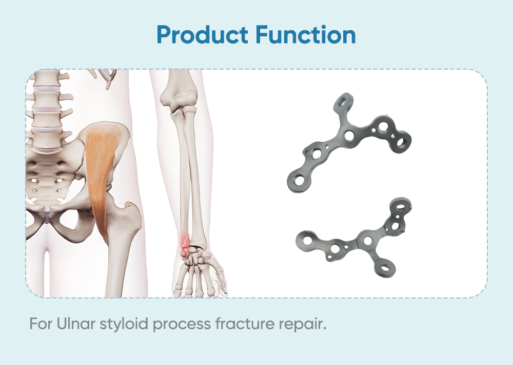 Locking Plate for Ulnar Styloid Process II - Buy Product on XC Medico Запирающая пластина для локтевого стилоидного процесса II — покупка продукта на XC Medico