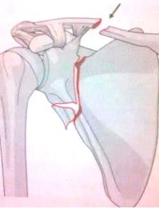 Diagnosis And Treatment Of Clavicle Fracture-16 Диагноз и лечение перелома ключицы-16
