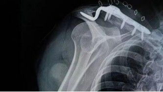 Diagnosis And Treatment Of Clavicle Fracture-27 Диагноз и лечение перелома ключицы-27