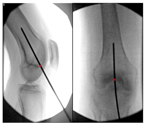 Femoral Intramedullary Nailing - How To Choose The Best Insertion Point-5 Бедренный интрамедуллярный гвоздь – как выбрать лучшую точку введения-5