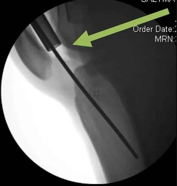 Tibial fractures, suprapatellar intramedullary nail technique-22 Переломы большеберцовой кости, супрапателлярная интрамедуллярная техника стержня-22