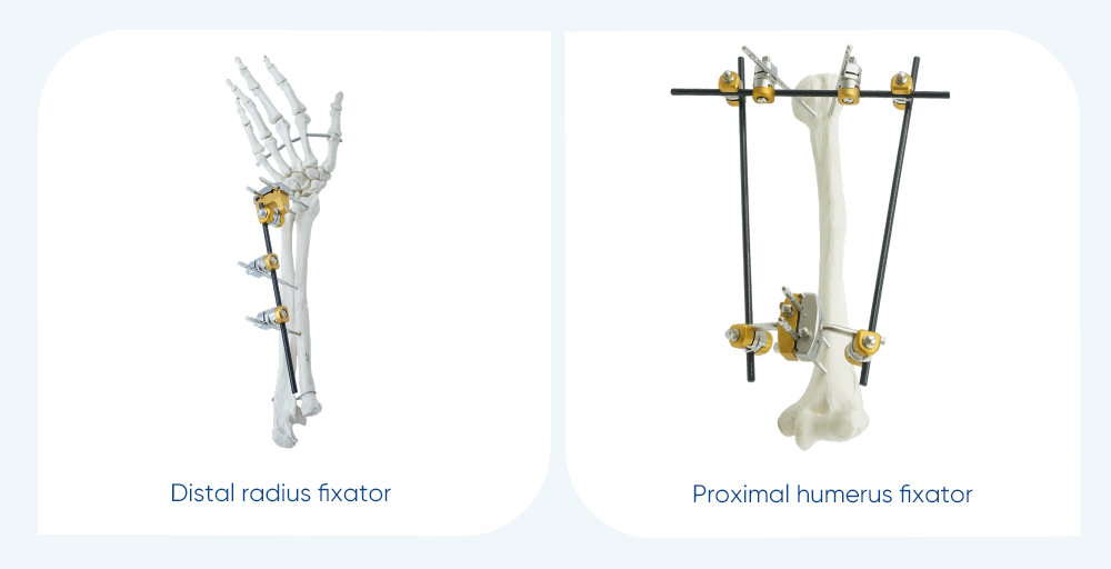 Upper Limb External Fixators - Buy Product on XC Medico покупка продукта на XC Medico Внешние фиксаторы верхних конечностей — покупка продукта на XC Medico