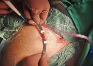 Diagnosis And Treatment Of Clavicle Fracture-23 Диагностика и лечение перелома клавиля-23