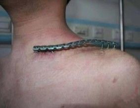 Diagnosis And Treatment Of Clavicle Fracture-28 Диагноз и лечение перелома ключицы-28