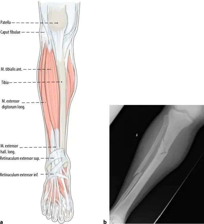 Tibial fractures, suprapatellar intramedullary nail technique-2 Переломы большеберцовой кости, супрапателлярная интрамедуллярная техника стержня-2