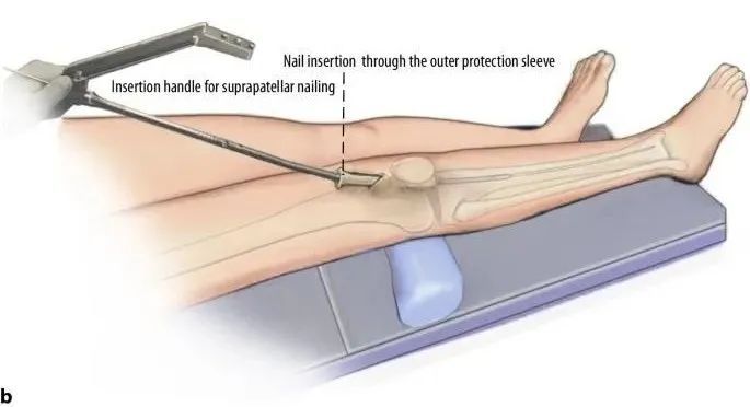 Tibial fractures, suprapatellar intramedullary nail technique-17 Переломы большеберцовой кости, супрапателлярная техника интрамедуллярного стержня-17