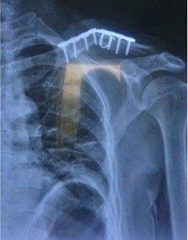 Diagnosis And Treatment Of Clavicle Fracture-31 Диагноз и лечение перелома ключицы-31