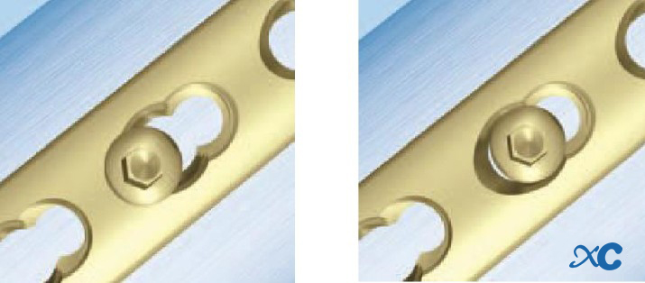 Proper Use Of The Locking Plate-13 Правильное использование стопорной пластины-13