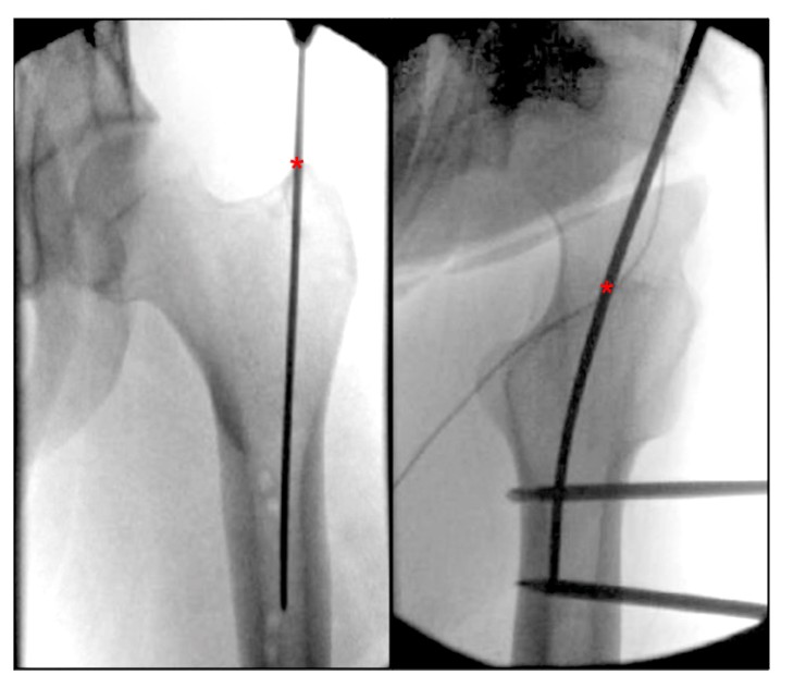 Femoral Intramedullary Nailing - How To Choose The Best Insertion Point-3 Бедренный интрамедуллярный гвоздь – как выбрать лучшую точку введения-3