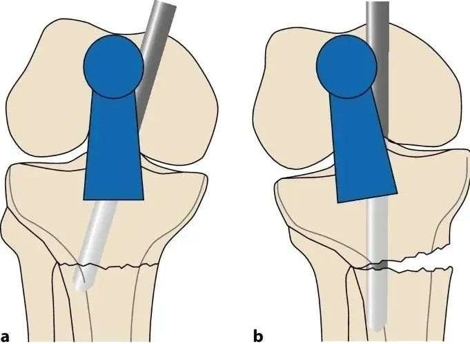 Tibial fractures, suprapatellar intramedullary nail technique-1 Переломы большеберцовой кости, супрапателлярная интрамедуллярная техника стержня-1