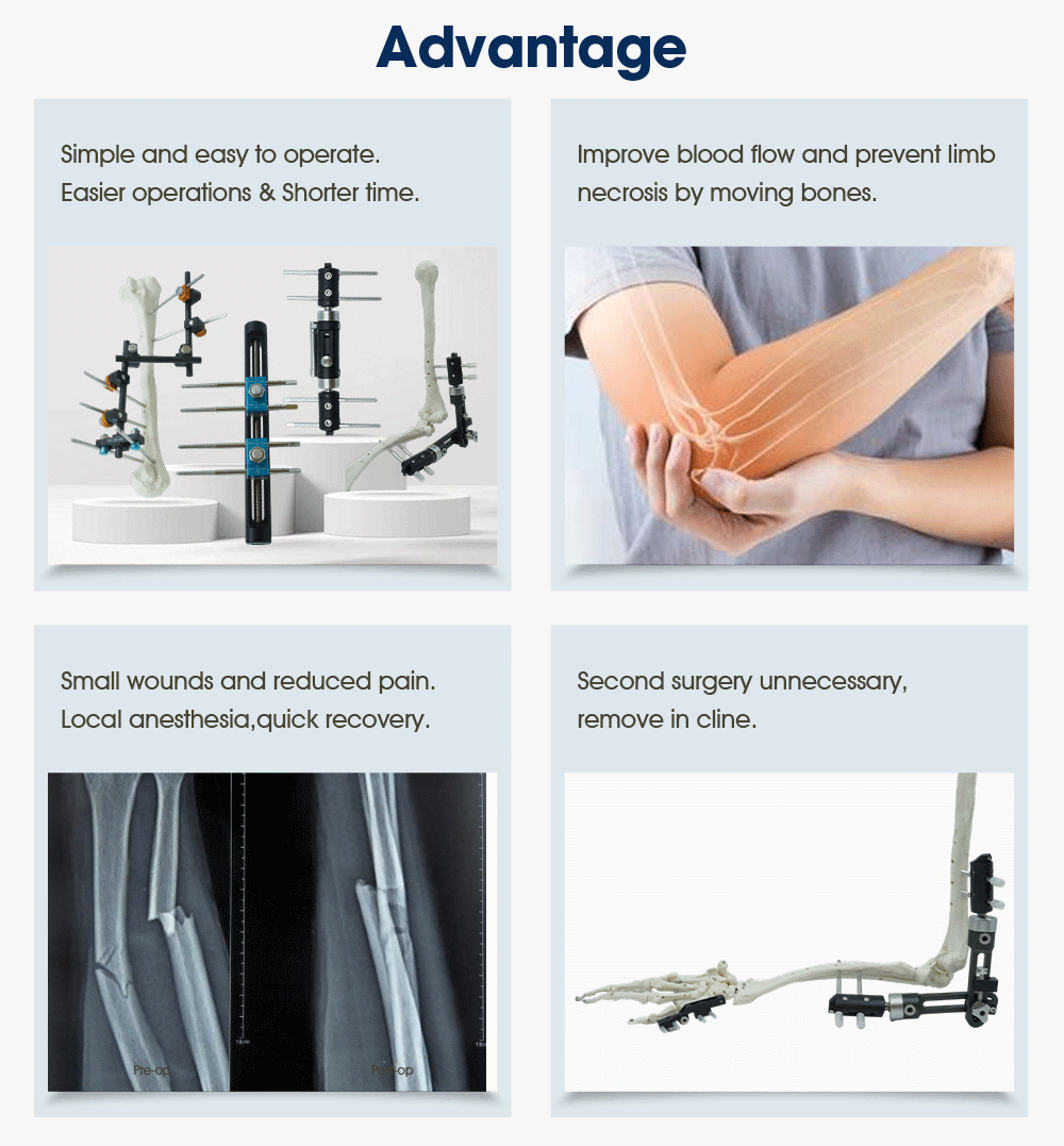 Upper Limb External Fixators - Buy Product on XC Medico Внешние фиксаторы верхних конечностей — покупка продукта на XC Medico