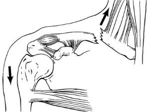 Diagnosis And Treatment Of Clavicle Fracture-2 Диагноз и лечение перелома клавиля-2