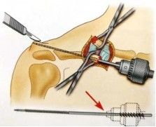 Diagnosis And Treatment Of Clavicle Fracture-18 Диагноз и лечение перелома ключицы-18