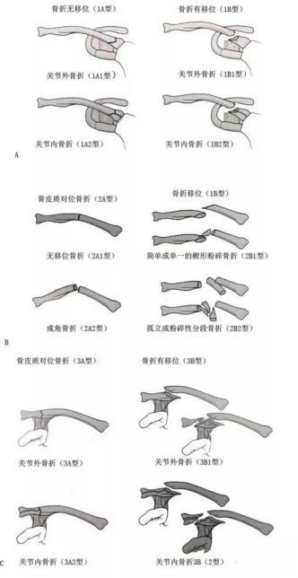 Diagnosis And Treatment Of Clavicle Fracture-14 Диагноз и лечение перелома ключицы-14