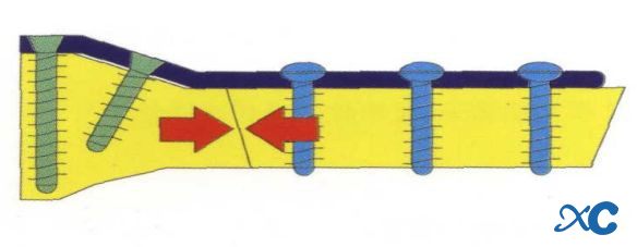 Proper Use Of The Locking Plate-8 Правильное использование стопорной пластины-8